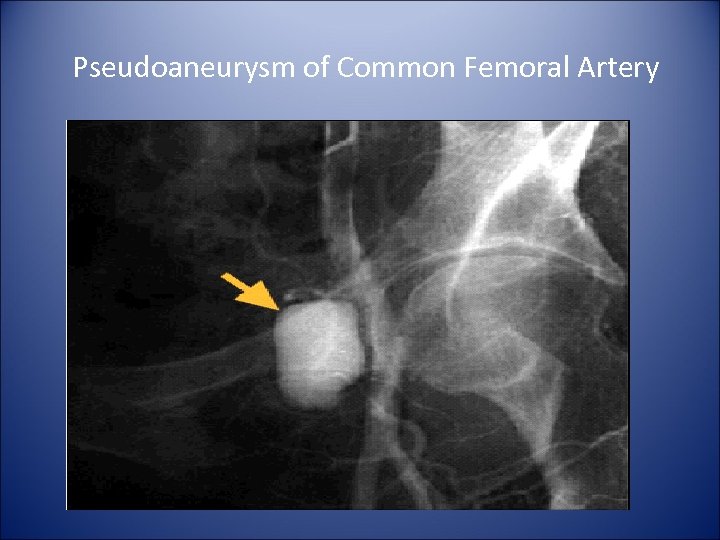 Pseudoaneurysm of Common Femoral Artery 