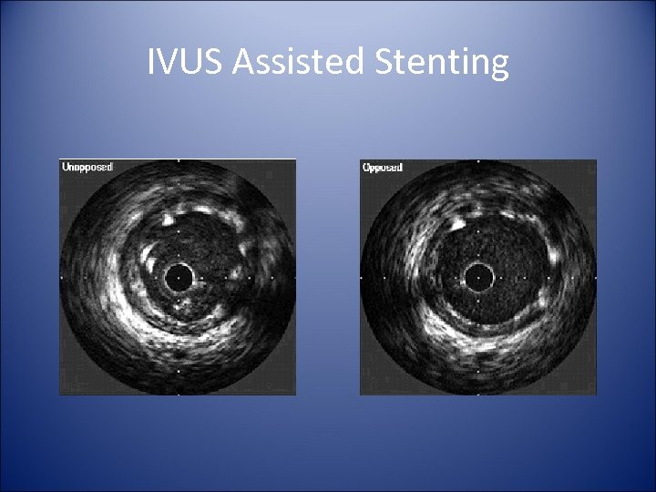 IVUS Assisted Stenting 