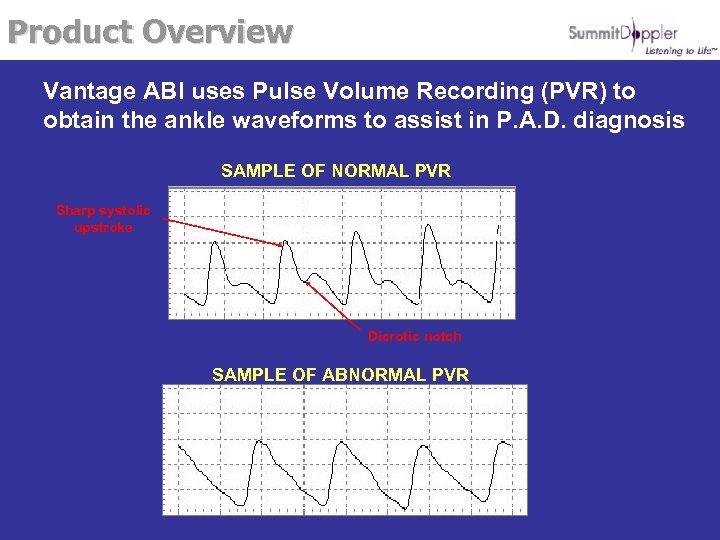 Product Overview Vantage ABI uses Pulse Volume Recording (PVR) to obtain the ankle waveforms