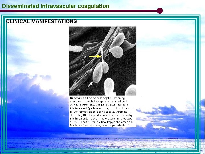Disseminated intravascular coagulation CLINICAL MANIFESTATIONS 