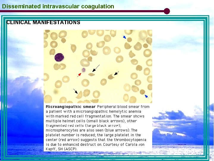 Disseminated intravascular coagulation CLINICAL MANIFESTATIONS 