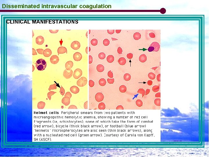 Disseminated intravascular coagulation CLINICAL MANIFESTATIONS 