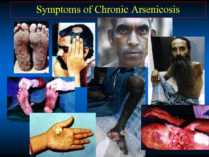 Symptoms of Chronic Arsenicosis 