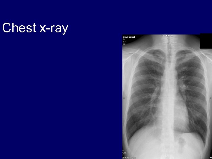 Chest x-ray 