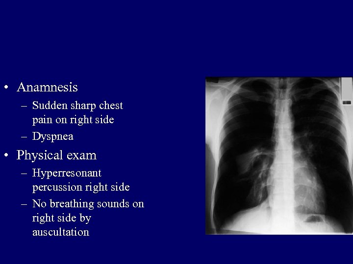  • Anamnesis – Sudden sharp chest pain on right side – Dyspnea •