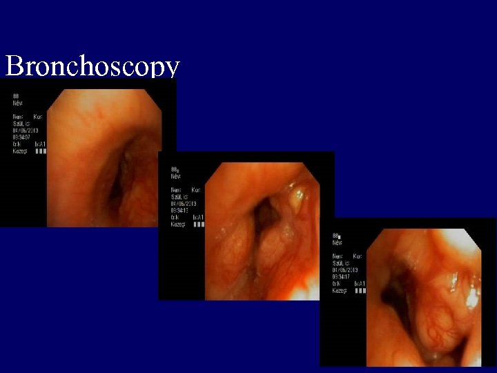 Bronchoscopy 