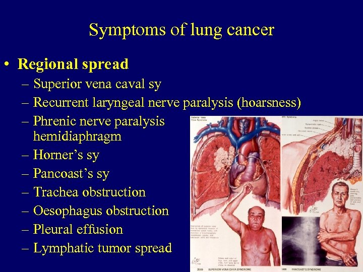 Symptoms of lung cancer • Regional spread – Superior vena caval sy – Recurrent