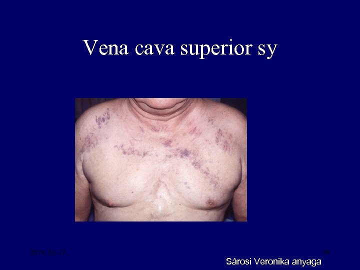 Vena cava superior sy 2018. 03. 17. 58 Sárosi Veronika anyaga 