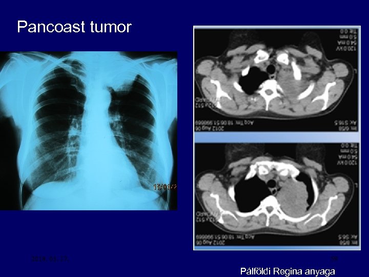 Pancoast tumor 2018. 03. 17. 59 Pálföldi Regina anyaga 