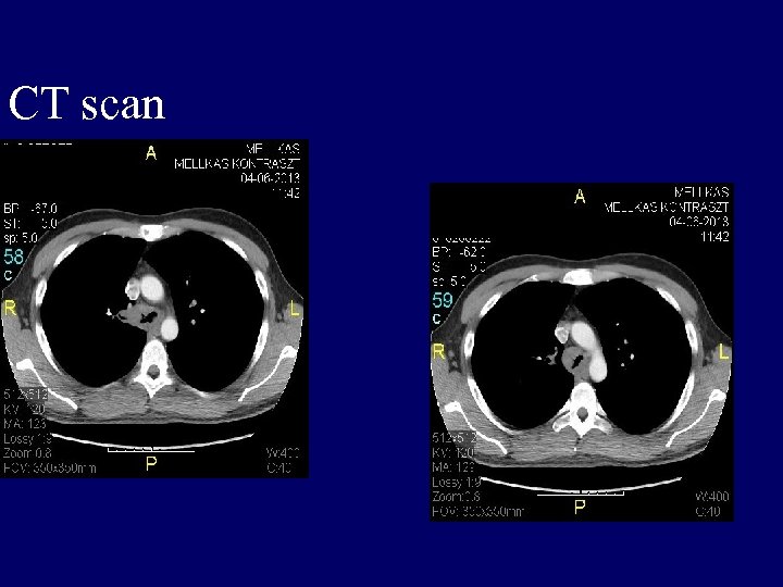 CT scan 