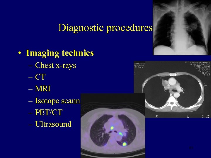 Diagnostic procedures • Imaging technics – Chest x-rays – CT – MRI – Isotope