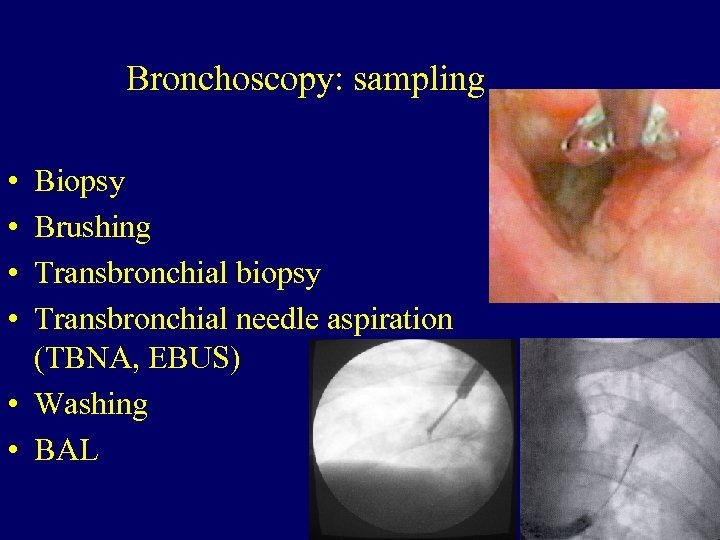 Bronchoscopy: sampling • • Biopsy Brushing Transbronchial biopsy Transbronchial needle aspiration (TBNA, EBUS) •