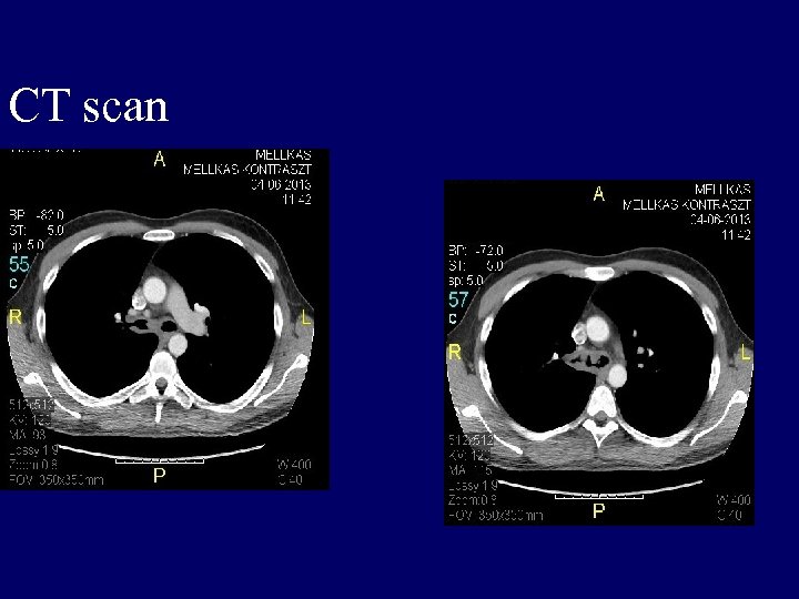 CT scan 