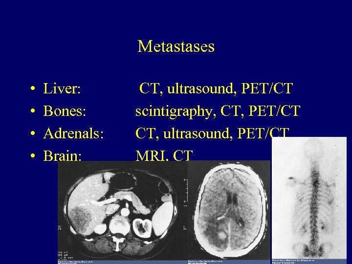 Metastases • • Liver: Bones: Adrenals: Brain: CT, ultrasound, PET/CT scintigraphy, CT, PET/CT CT,