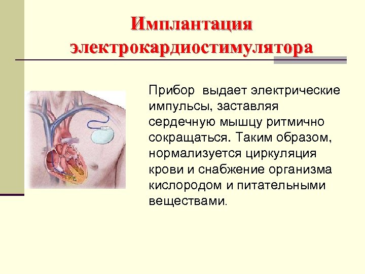 Имплантация электрокардиостимулятора Прибор выдает электрические импульсы, заставляя сердечную мышцу ритмично сокращаться. Таким образом, нормализуется