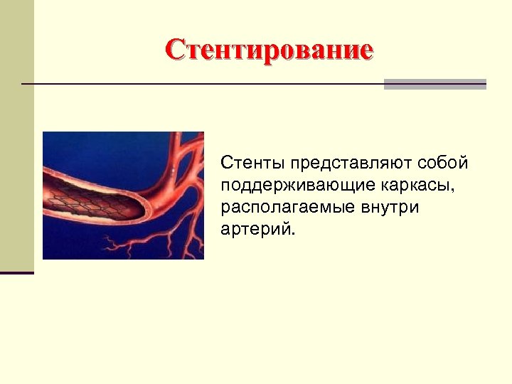 Стентирование Стенты представляют собой поддерживающие каркасы, располагаемые внутри артерий. 