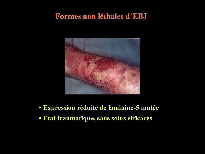 Formes non léthales d’EBJ • Expression réduite de laminine-5 mutée • Etat traumatique, sans