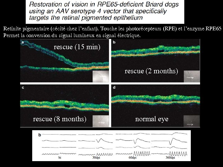 Retinite pigmentaire (cécité chez l’enfant). Touche les photorécepteurs (RPE) et l’enzyme RPE 65 Permet
