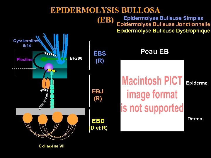 EPIDERMOLYSIS BULLOSA Epidermolyse Bulleuse Simplex (EB) Epidermolyse Bulleuse Jonctionnelle Epidermolyse Bulleuse Dystrophique Cytokeratines 5/14