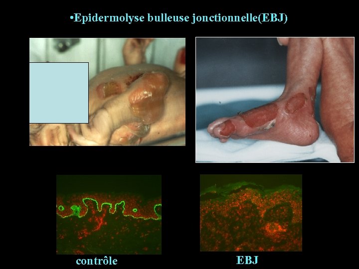  • Epidermolyse bulleuse jonctionnelle(EBJ) * contrôle * EBJ * 