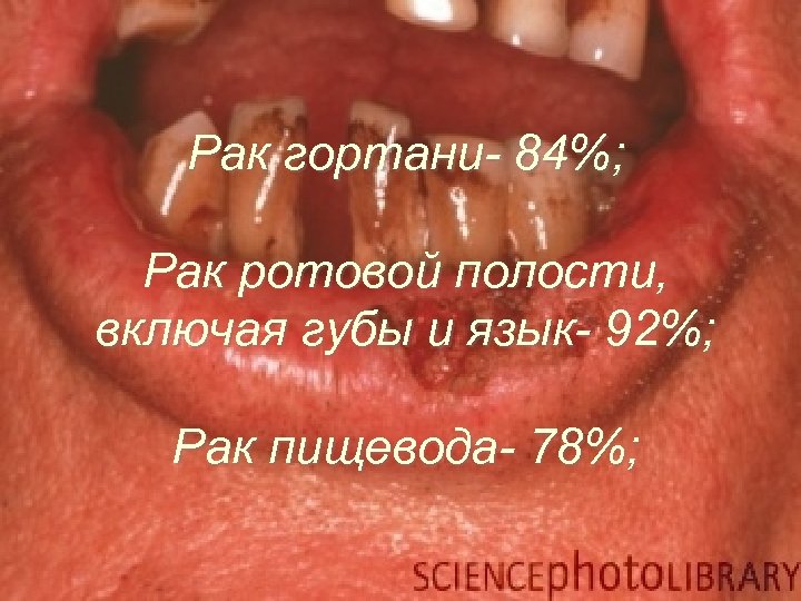 Рак гортани- 84%; Рак ротовой полости, включая губы и язык- 92%; Рак пищевода- 78%;