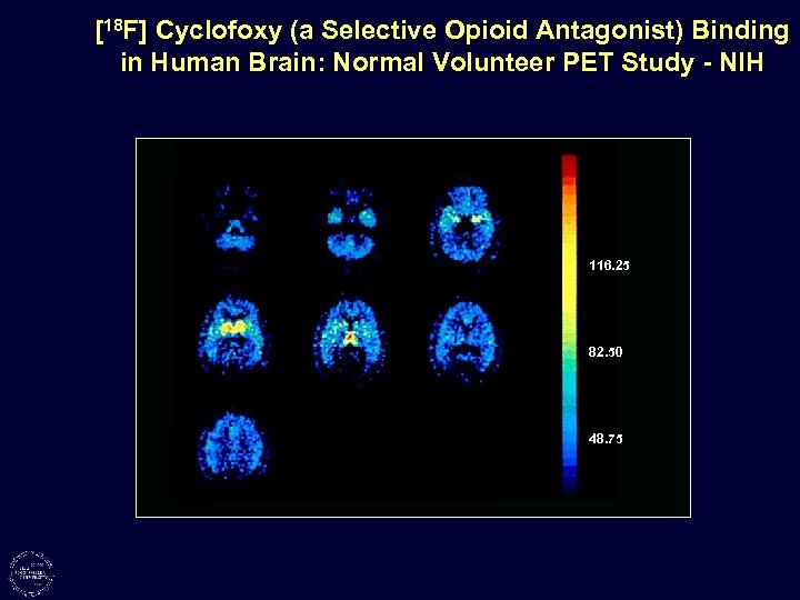 [18 F] Cyclofoxy (a Selective Opioid Antagonist) Binding in Human Brain: Normal Volunteer PET