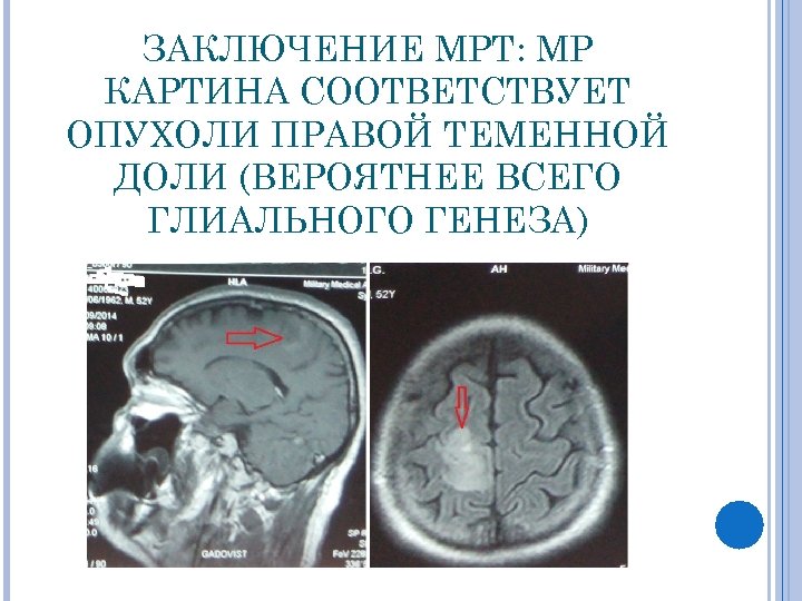 Мр признаки что это означает в мрт. Опухоль правой теменной доли. Клинические проявления опухоли теменной доли:. Опухоль теменной доли мрт.