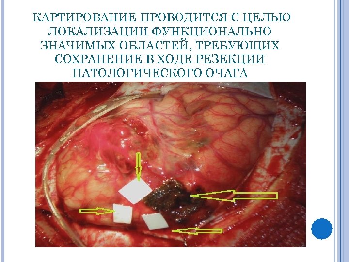 КАРТИРОВАНИЕ ПРОВОДИТСЯ С ЦЕЛЬЮ ЛОКАЛИЗАЦИИ ФУНКЦИОНАЛЬНО ЗНАЧИМЫХ ОБЛАСТЕЙ, ТРЕБУЮЩИХ СОХРАНЕНИЕ В ХОДЕ РЕЗЕКЦИИ ПАТОЛОГИЧЕСКОГО