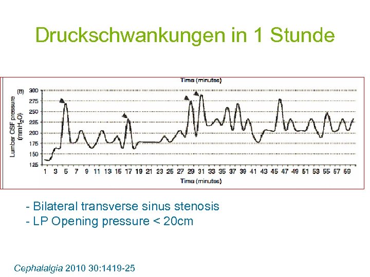 Druckschwankungen in 1 Stunde - Bilateral transverse sinus stenosis - LP Opening pressure <