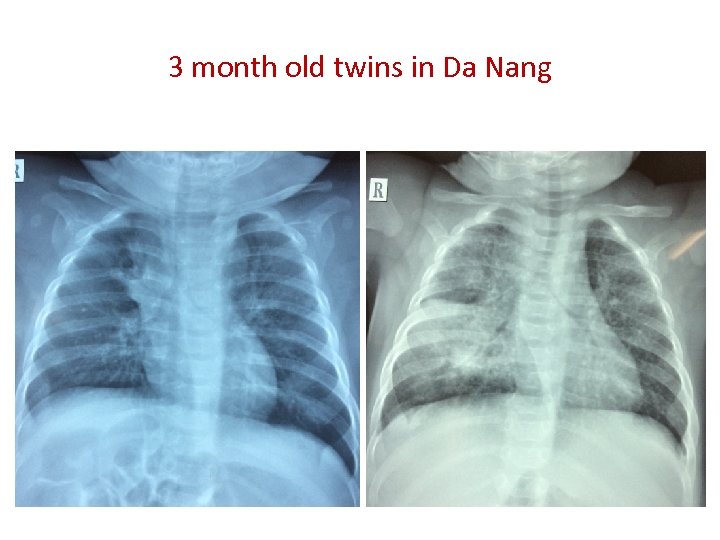 3 month old twins in Da Nang 