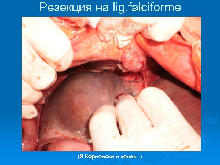 Резекция на lig. falciforme (Я. Корновски и колект. ) 