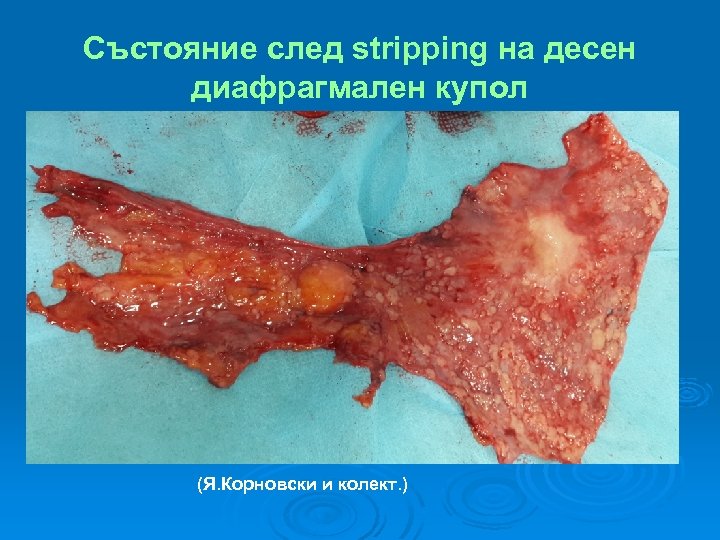 Състояние след stripping на десен диафрагмален купол (Я. Корновски и колект. ) 