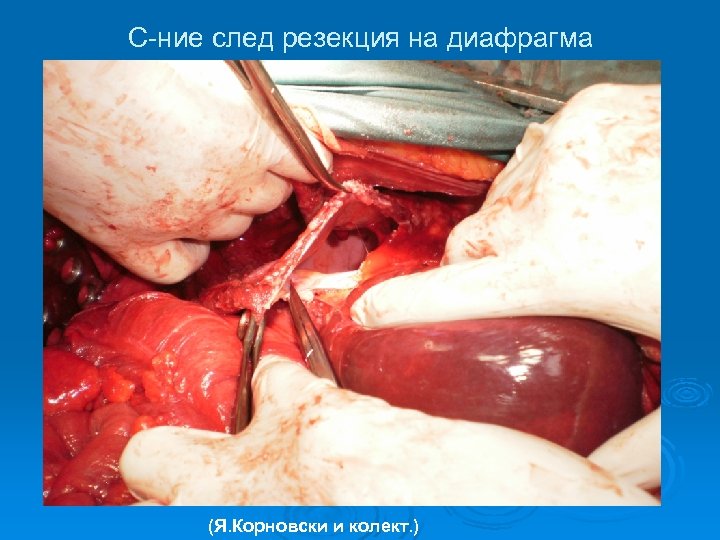 С-ние след резекция на диафрагма (Я. Корновски и колект. ) 