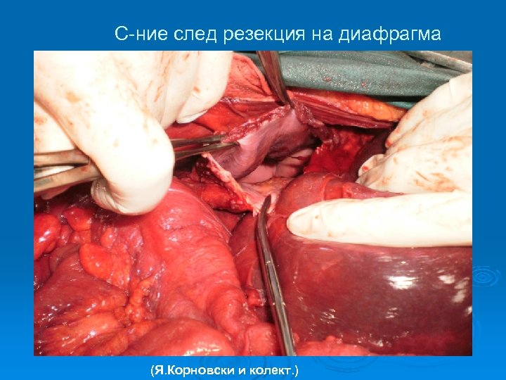 С-ние след резекция на диафрагма (Я. Корновски и колект. ) 
