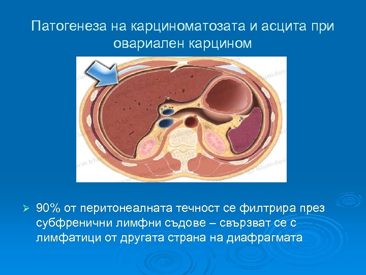 Патогенеза на карциноматозата и асцита при овариален карцином Ø 90% от перитонеалната течност се