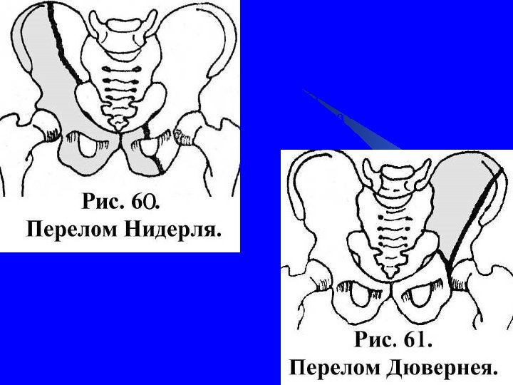 Осложнения перелома таза