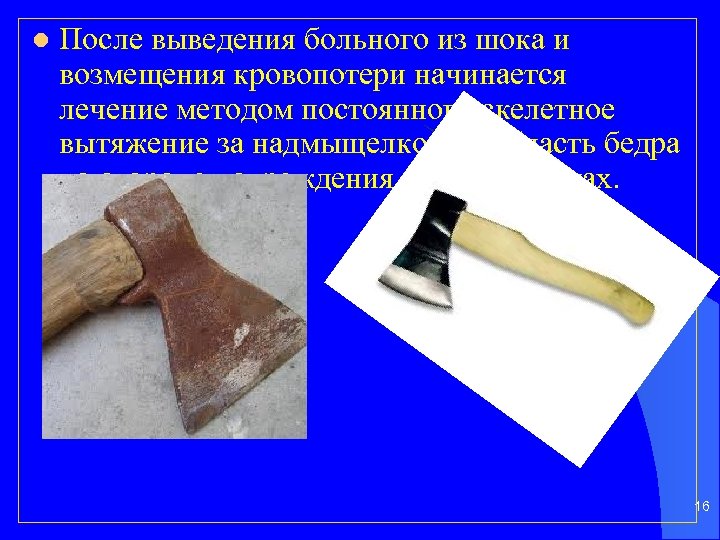 l После выведения больного из шока и возмещения кровопотери начинается лечение методом постоянного скелетное