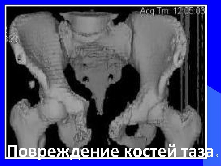 Повреждение костей таза 3 