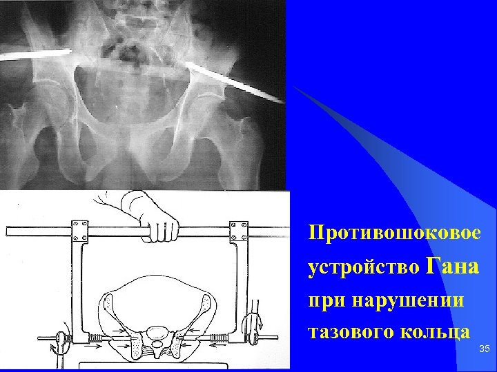 Противошоковое устройство Гана при нарушении тазового кольца 35 
