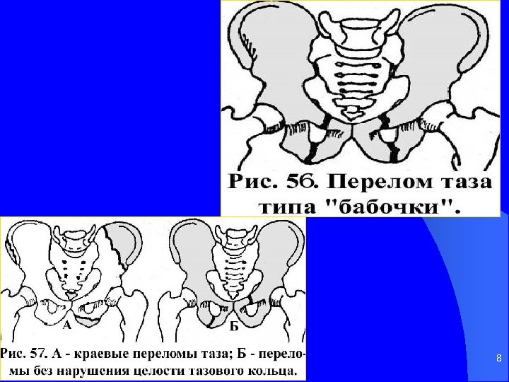 Перелом таза б