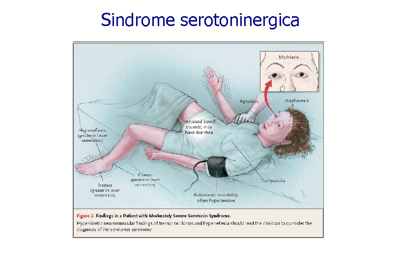 Sindrome serotoninergica 