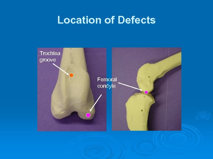 Location of Defects Trochlea groove Femoral condyle 