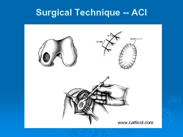 Surgical Technique -- ACI www. carticel. com 