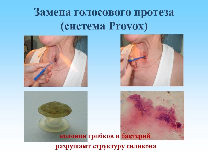 Замена голосового протеза (система Provox) колонии грибков и бактерий разрушают структуру силикона 