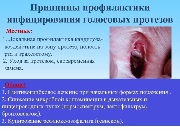 Принципы профилактики инфицирования голосовых протезов Местные: 1. Локальная профилактика кандидозавоздействие на зону протеза, полость