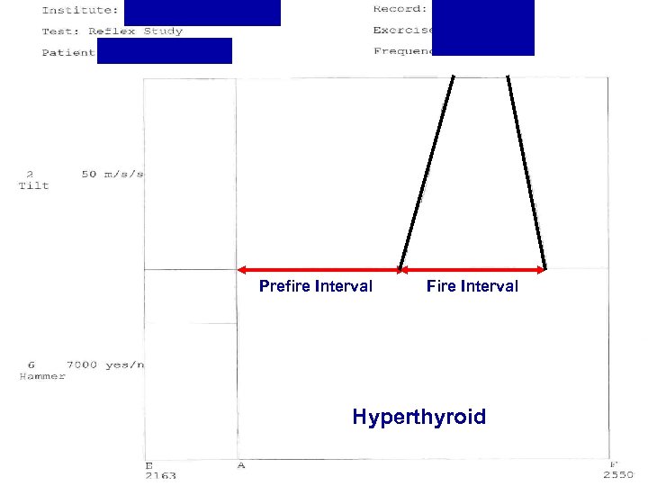 Prefire Interval Fire Interval Hyperthyroid 