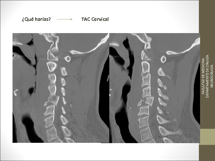 FACULTAD DE MEDICINA DEPARTAMENTO DE CIRUGÍA NEUROCIRUGÍA ¿Qué harías? TAC Cervical 