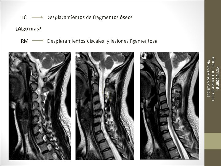TC Desplazamientos de fragmentos óseos ¿Algo mas? FACULTAD DE MEDICINA DEPARTAMENTO DE CIRUGÍA NEUROCIRUGÍA