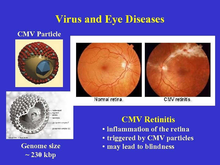 Virus and Eye Diseases CMV Particle CMV Retinitis Genome size ~ 230 kbp •