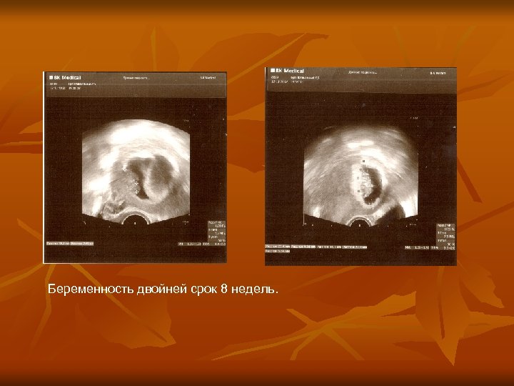 Беременность двойней срок 8 недель. 